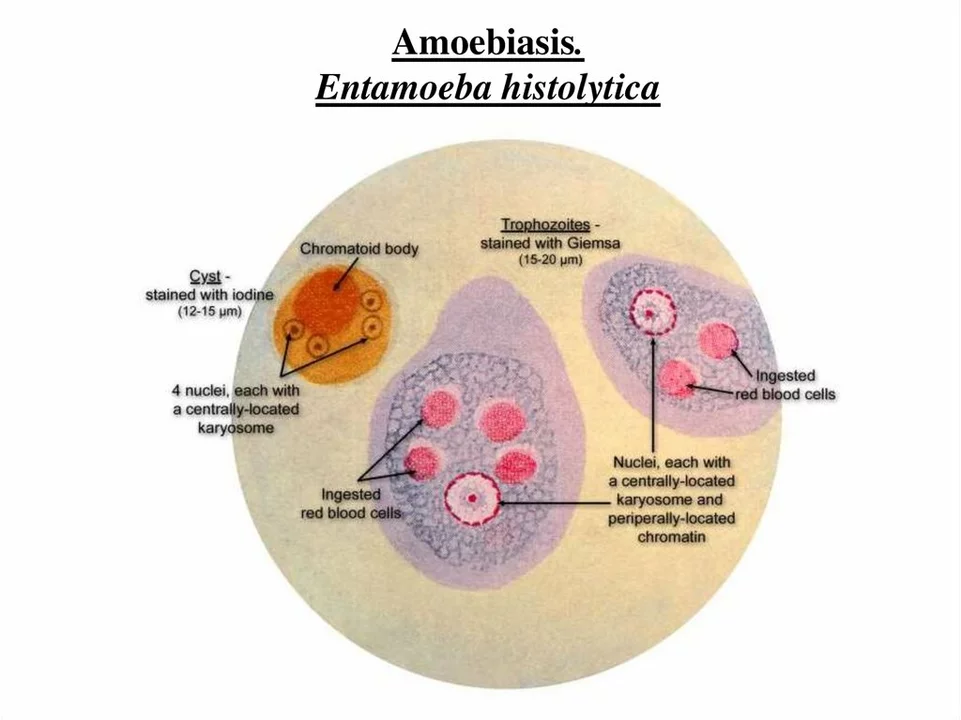 Amebiasis and the Healthcare System: The Cost of Infection